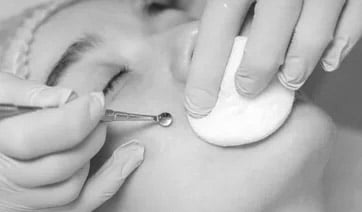 woman-blackhead-removal